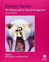 9781405138895-1405138890-Dental Caries: The Disease and Its Clinical Management