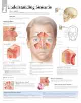 9781932922691-1932922695-Understanding Sinusitis chart: Laminated Wall Chart