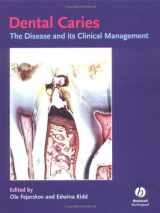 9781405107181-1405107189-Dental Caries: The Disease and Its Clinical Management