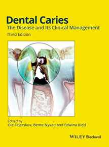 9781118935828-1118935829-Dental Caries: The Disease and Its Clinical Management