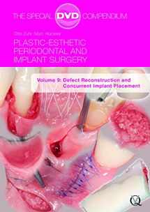 9781850972488-1850972486-Plastic-Esthetic Periodontal and Implant Surgery, Volume 9: Defect Reconstruction and Concurrent Implant Placement