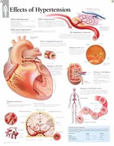 Effects of Hypertension chart: Laminated Wall Chart